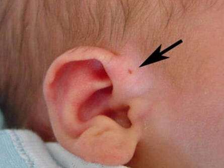 宝宝耳朵旁边的小洞，..