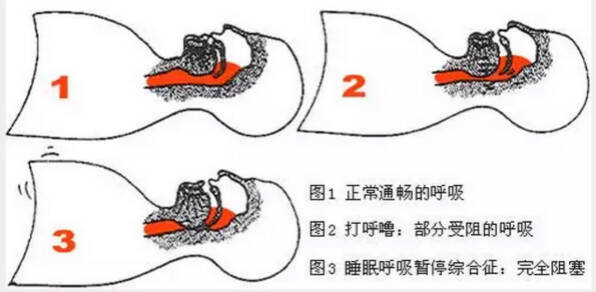 引发夜间猝死的原因,竟是打呼噜?