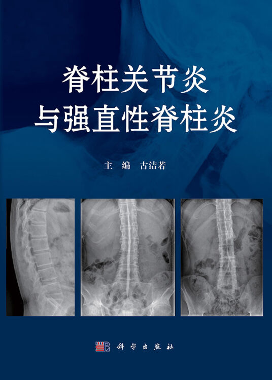 脊柱关节炎与强直性脊柱炎