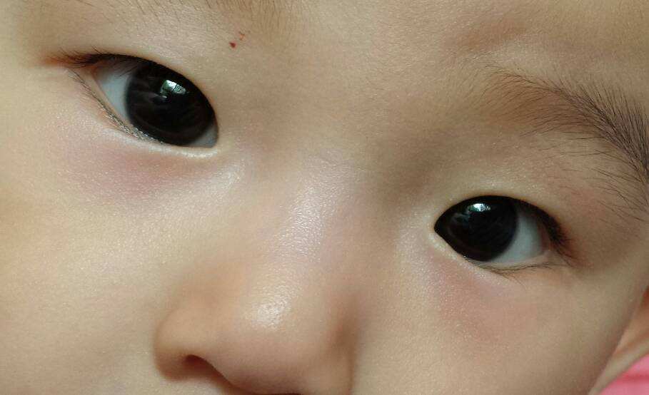 发现孩子熊猫眼,竟是鼻炎惹的祸!