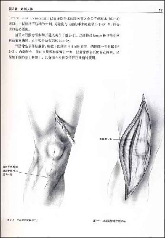 膝关节置换术(第2版)