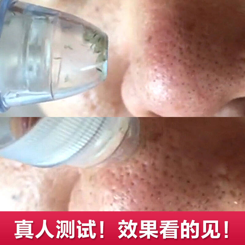 康茵美(KYM)吸黑头仪器毛孔清洁器 去吸黑头机器 电子美容仪器家用收毛孔粉刺 玫瑰金 - 京东