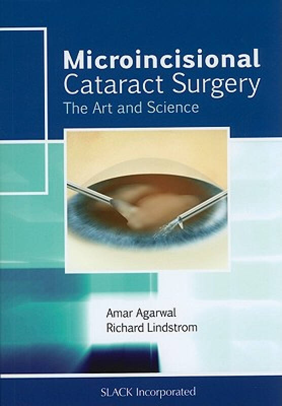 cataract,divergence 【预订】microincisional cataract surgery: the