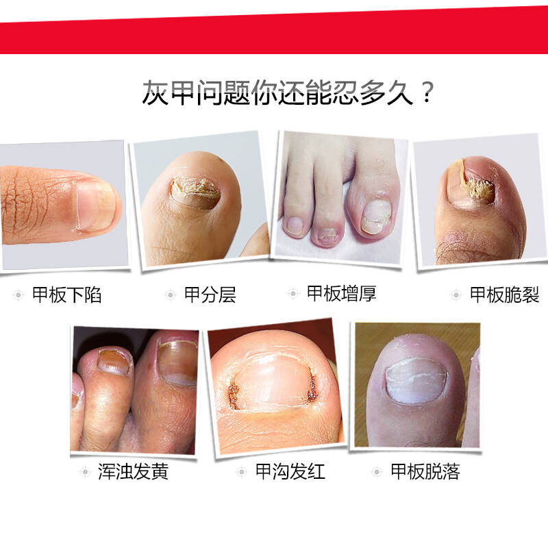【买2送1】去除灰指甲√修护甲根√亮甲√美甲√ 灰甲