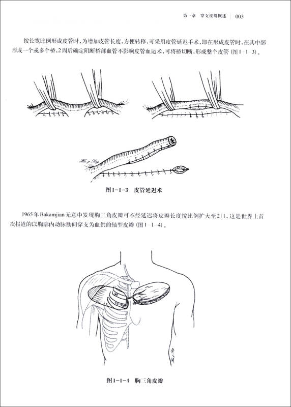 穿支皮瓣手术图解