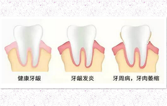 超声波洗牙注意事项大起底前后注意7件小事效