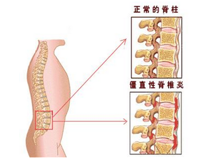 脊柱炎的早期症状脊柱炎的初期症状