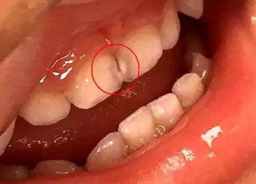 牙齿烂个洞_小孩子牙齿烂个洞该怎么办_牙齿烂个洞不痛