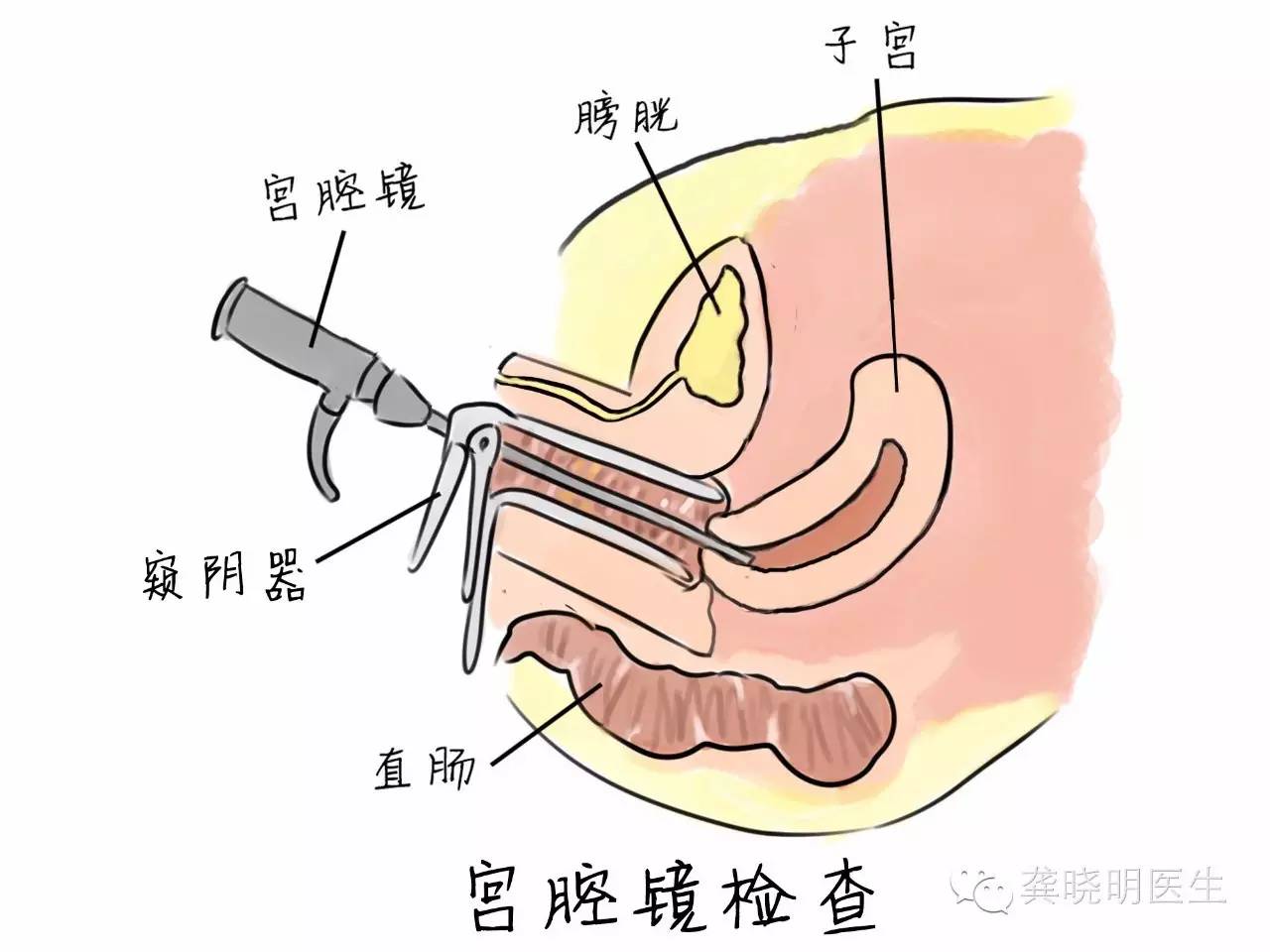 若是在宫腔镜检查下发现人质已经被策反了,通常还会需要活检来获得