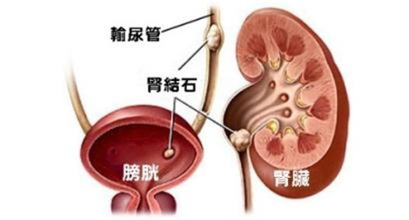 结石的症状结石有哪些症状_结石有什么症状