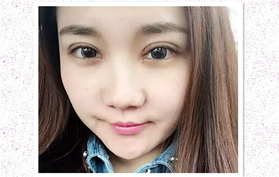 全切双眼皮加开眼角26天,眼皮肿得眼线都画不上了,也不敢画到眼角