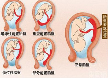 孕妈胎盘成熟了?当心影响到分娩和胎儿健康