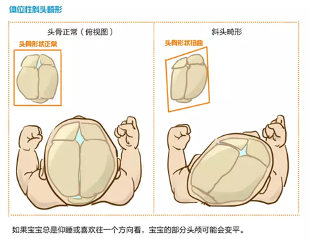 两个月宝宝头睡偏了怎么纠正?