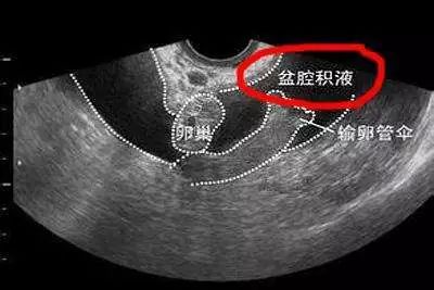 盆腔积液到底需不需要治疗?