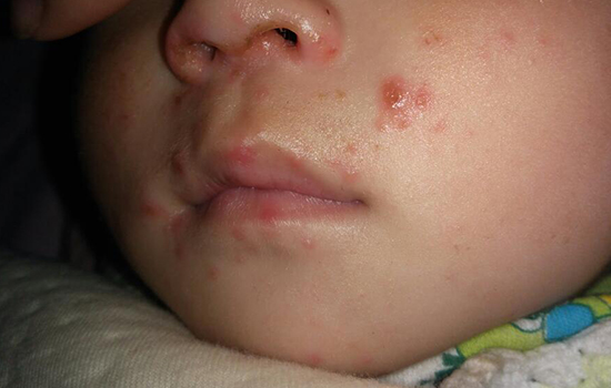幼儿急疹和水痘的区别 五大区别避免再混淆