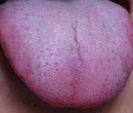 艾滋病舌头图片艾滋病舌头早期症状_艾滋病舌头是什么