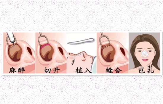 耳软骨鼻小柱延长的方法 第一步备皮: 做鼻小柱延长手术前,医生首先