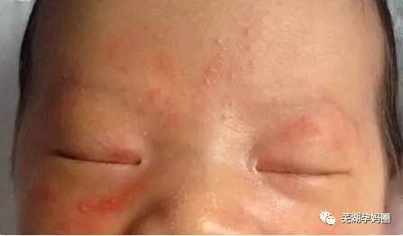 在新生儿的脸部,额头又出现丘疹或者脓疱样的疹子.
