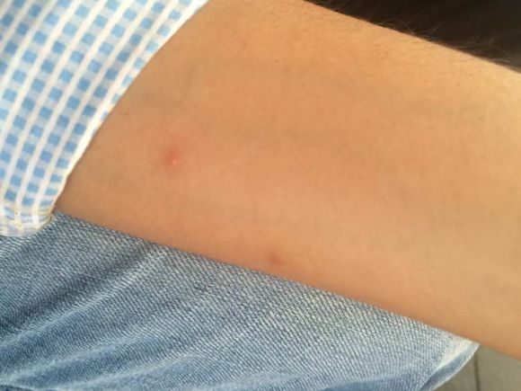 人工荨麻疹的有效治疗偏方?怎么解决啊