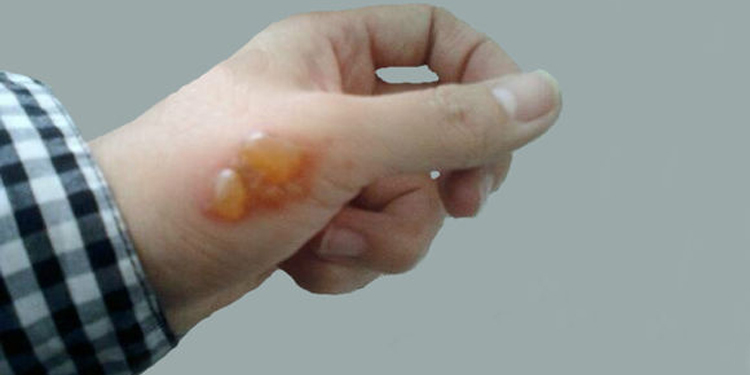 手被烫伤起泡怎么办手烫伤的注意事项- 京东