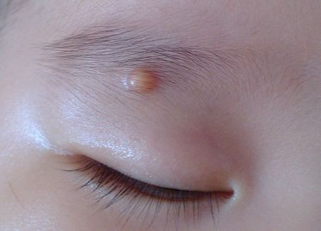 眉毛长痘痘是什么原因眉头长痘痘是什么原因