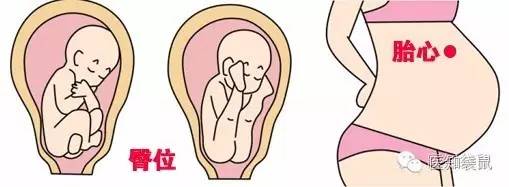 正文   胎儿6个月以后:随着胎儿的生长和胎位的不同,胎心的位置也是不