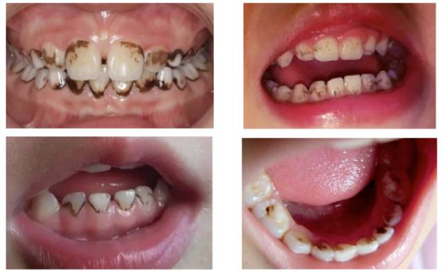 牙齿变黑的常见原因还有一个,也就是今天我要给大家介绍的:牙面色素沉