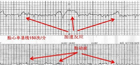 胎宝宝的心跳频率多少才算正常呢?