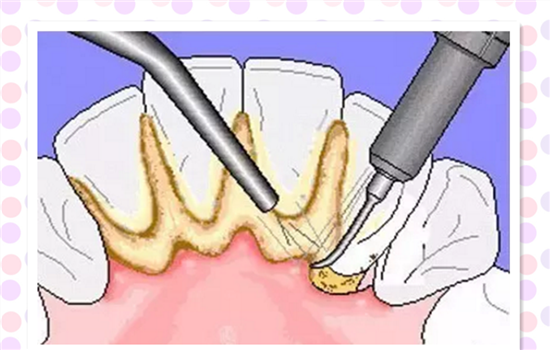 超声波洗牙的原理是怎样的原来超声波洗牙是这