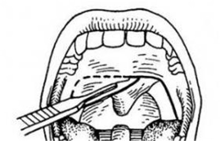 悬雍垂悬雍垂是什么_悬雍垂的作用