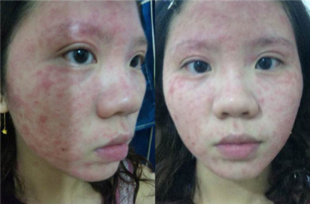 脸过敏发红痒怎么办脸过敏发红发痒怎么办_面部过敏发红发痒怎么办- 京东