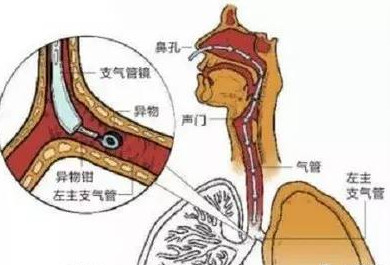 窒息,气管异物,烫伤……如何避免宝宝遭受这些意外伤害?