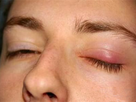 眼脸炎眼脸炎的症状_眼脸炎怎么治疗