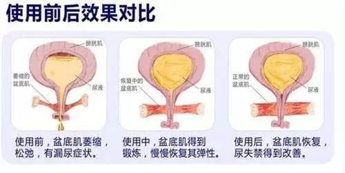 盆底肌肉康复原理及基本原则是什么?产后盆底康复主要