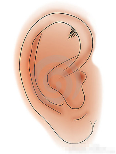 耳朵后面长了个疙瘩耳朵后面长了个疙瘩怎么办_耳朵后面长了个硬包