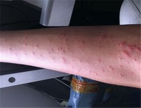 备孕得了荨麻疹怎么办备孕期间荨麻疹怎么治疗