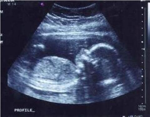 b超单看胎儿性别如何从b超单看胎儿性别_b超