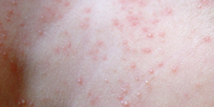 长热痱子怎么办内外兼顾快速缓解- 京东