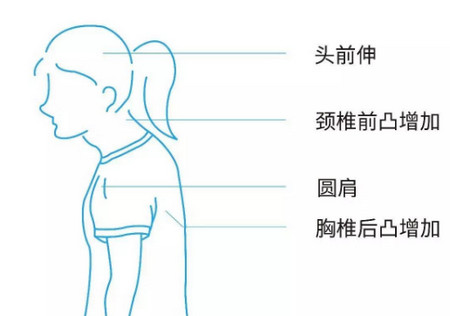 上下交叉综合症怎么回事?产后瘦不下来竟因为它!