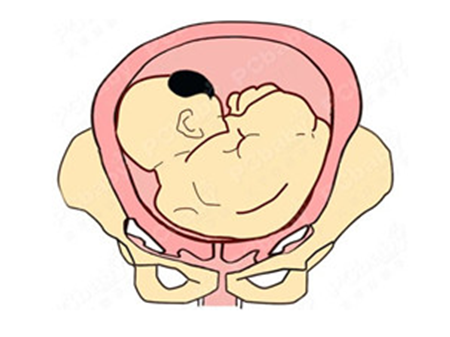 胎位不正分几种胎位不正有哪些_常见胎位不正有几种