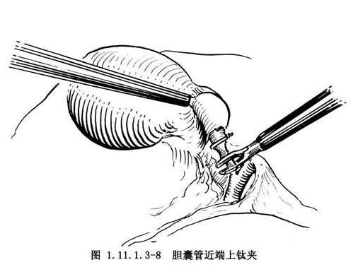 腹腔镜胆囊切除术腹腔镜胆囊切除术步骤_腹腔镜胆囊切除术后护理常规