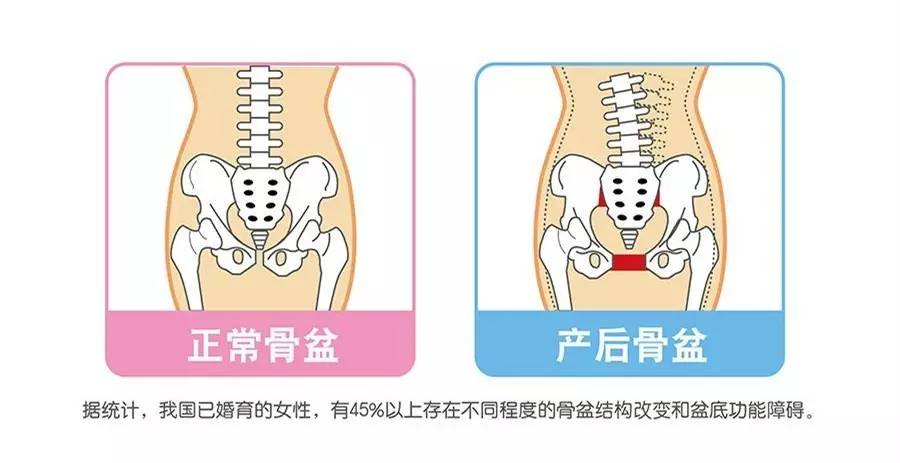 产后骨盆修护为什么一定要做?