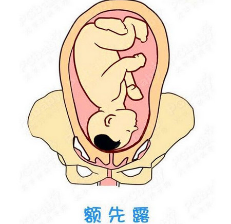 详解:妈妈生产最难的腹中胎儿姿势