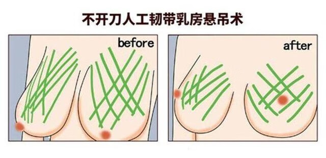 乳头下垂是什么原因造成的(乳房下垂是什么原因)