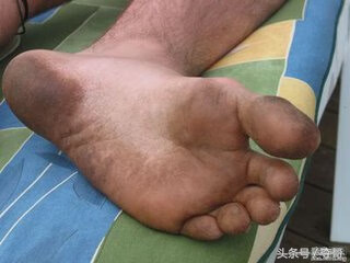 去脚臭的简单小窍门(为什么脚臭,洗了也一样)