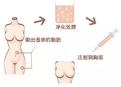 明星怎么隆胸(怎样让胸变得越来越大)