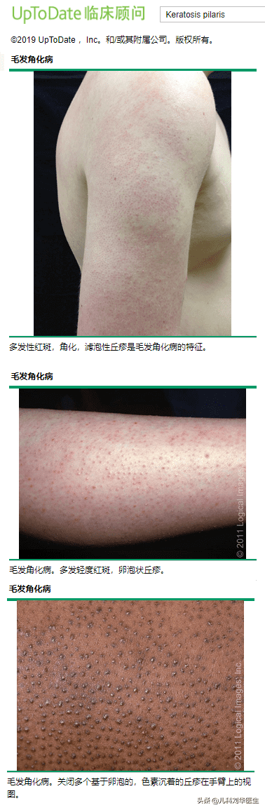 鸡皮疙瘩皮肤病(如何去除鸡皮肤小窍门)