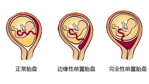 胎盘位置低能顺产吗?(胎盘过低可以顺产吗)