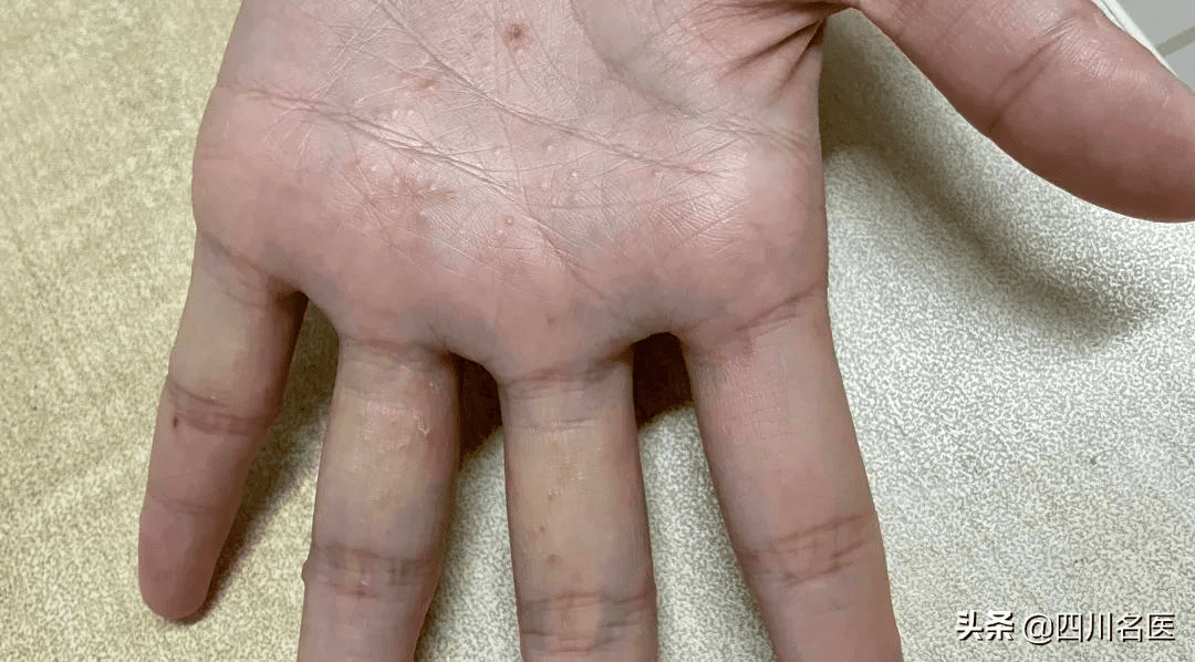 手脱皮是什么原因导致的(手脱皮是什么现象)