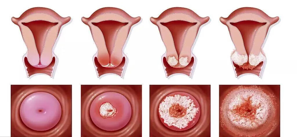 宫颈柱状上皮异位图片图片